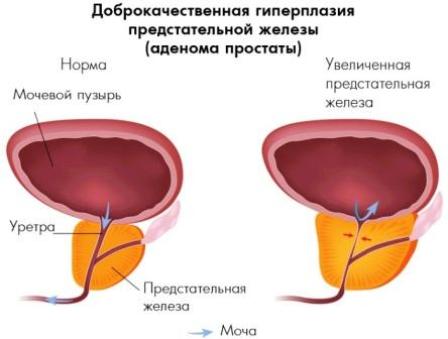 картинка аденомы простаты