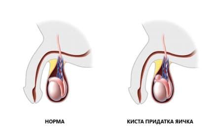 инфограма пузырька на придатке тестикул