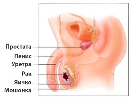 инфограма рака тестикул