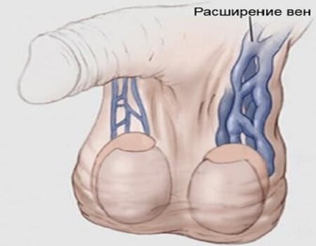 инфограма варикоцеле