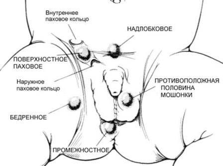 инфограма возможного расположения места тестикул у мальчиков