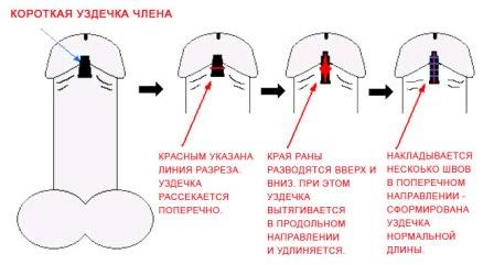 инстаграма лечения короткой уздечки