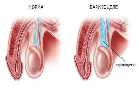 инстаграма варикоцеле