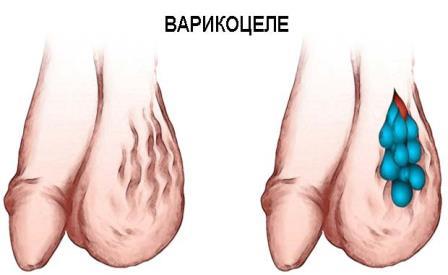 инстаграма варикозного расширения вен яичек