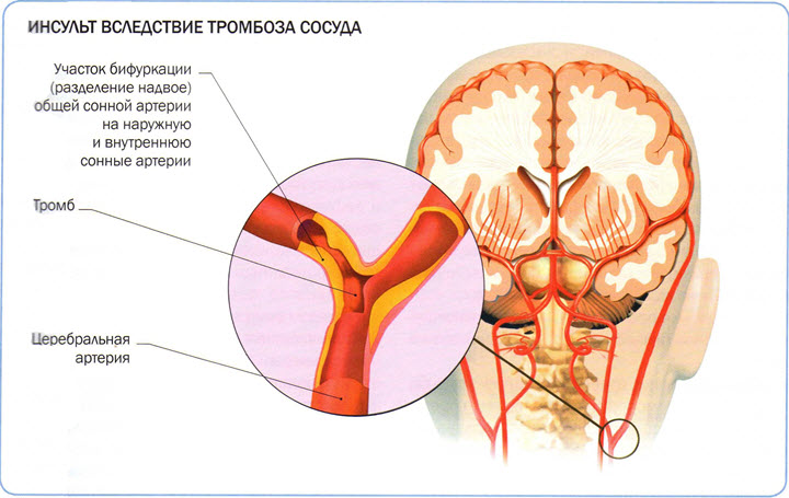 Схема инсульта