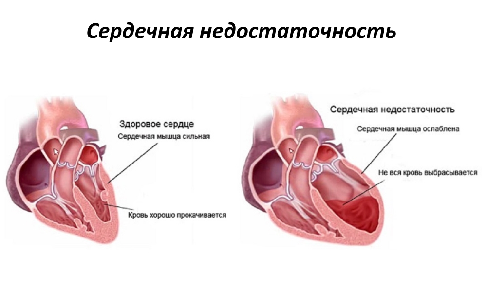 Сердечная недостаточность. Причины, симптомы и лечение
