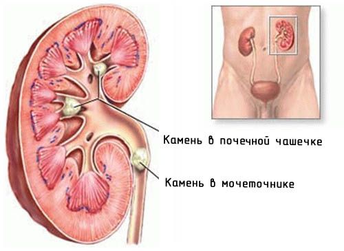 рисунок камней в почках