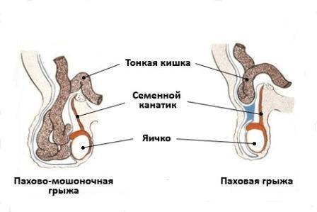 картинка паховой грыжи