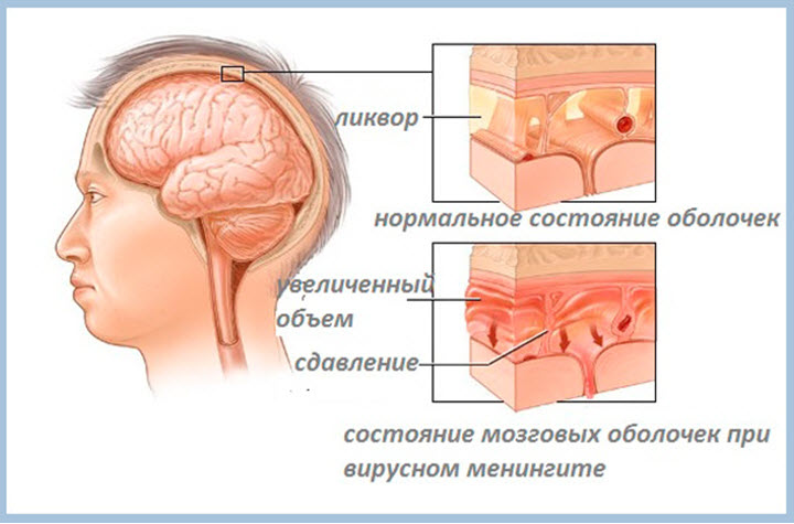 Состояние оболочек при менингите