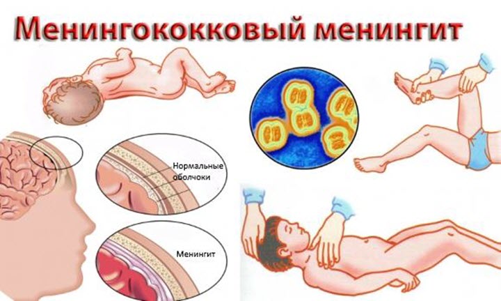 Менингококковый менингит