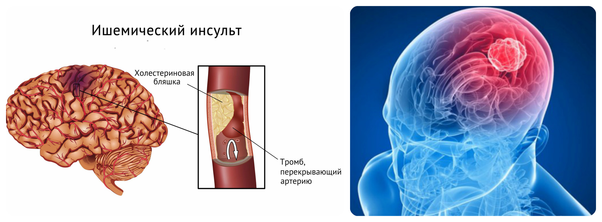 Ишемический инсульт: симптомы, лечение и последствия