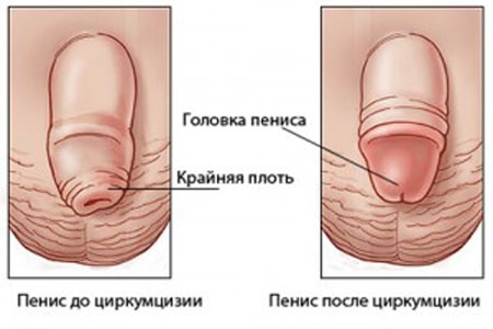 пенис до и после циркумцизии