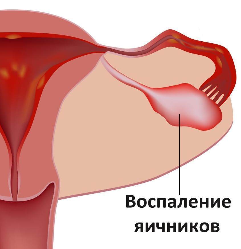 Воспаление яичников. Симптомы и лечение