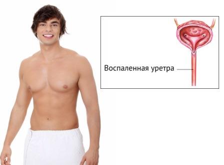 парень и инстаграма воспаления уретры