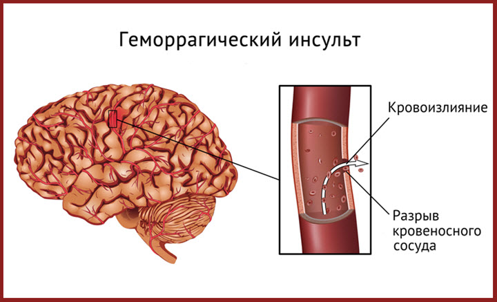 Геморрагический инсульт