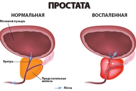 простата