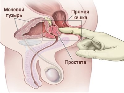 массаж простаты