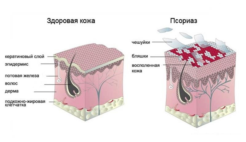 рисунок здоровой кожи и с псориазом
