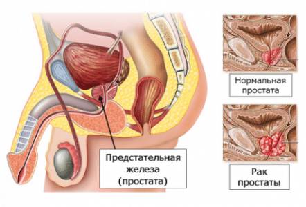 инфограмма предстательной железы