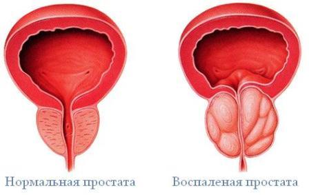 рисунок нормальной простаты и аденомы