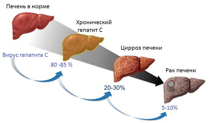 печень в разном состоянии