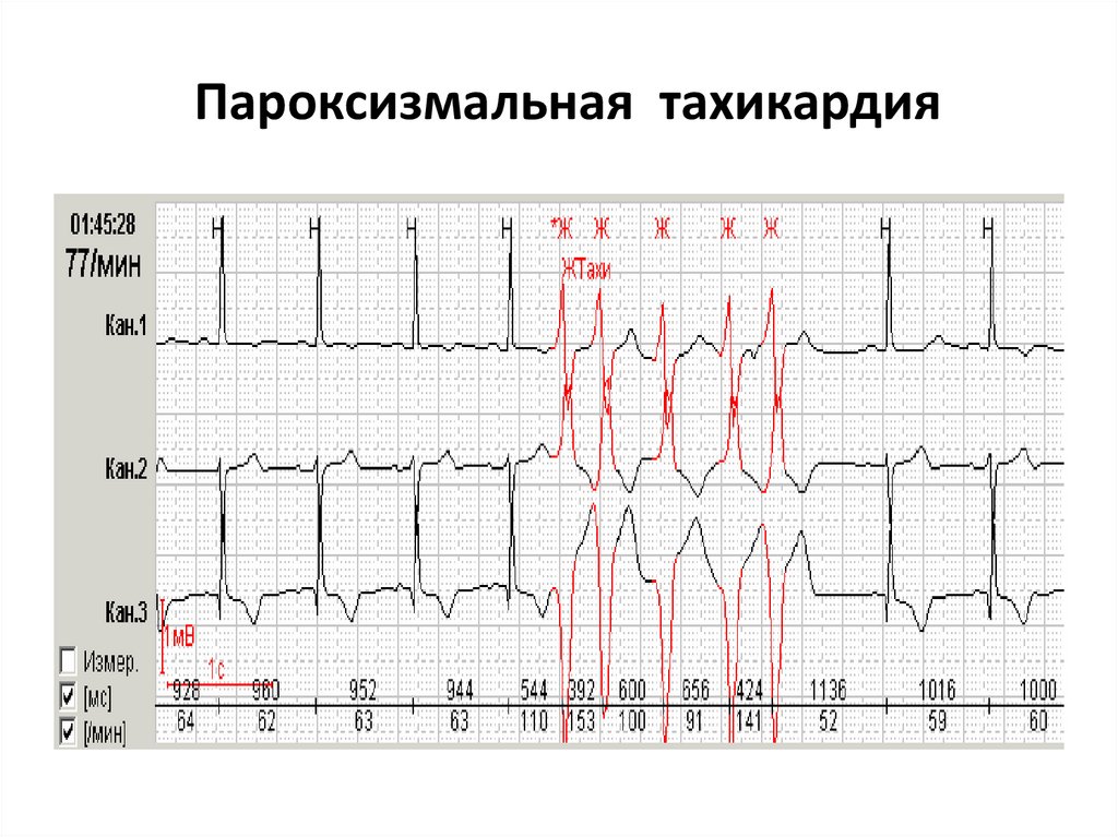 Пароксизмальная тахикардия. Причины, симптомы и лечение