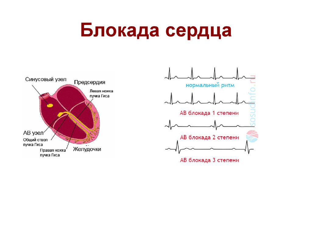 Блокада сердца. Причины, степени, симптомы и лечение