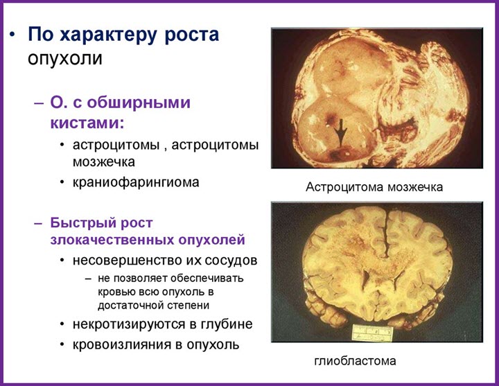 Виды опухолей мозга