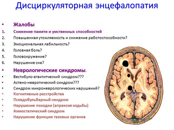 Признаки дисциркулярной энцефалопатии