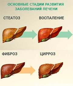 стадии заболевания