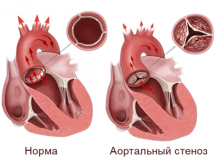 Аортальный стеноз. Степени, симптомы, причины и лечение