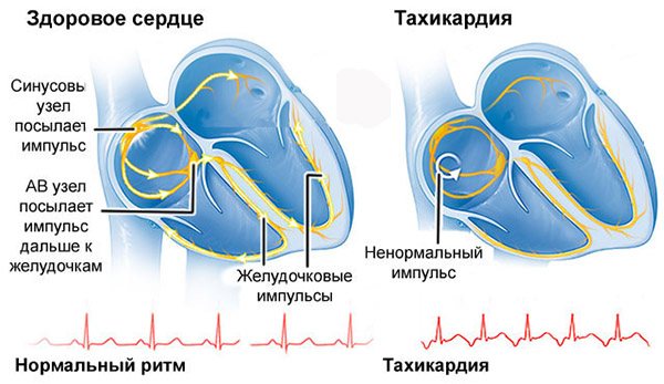 Тахикардия: симптомы, причины, профилактика и лечение