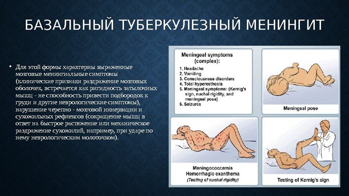 Основные симптомы менингита