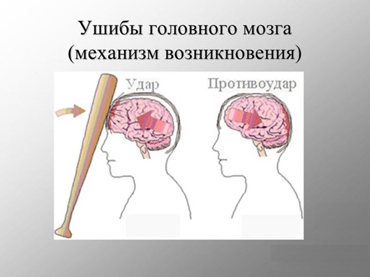 Травма головного мозга