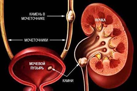 камни в почках