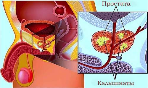 рисунок наличия кальцинатов в простате