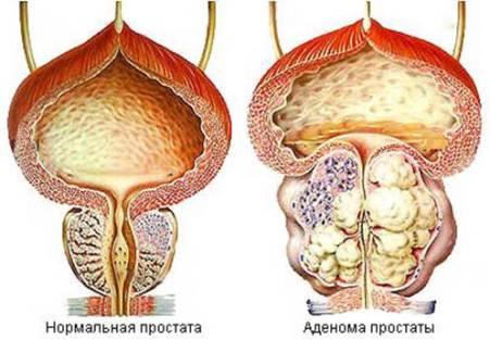 воспаление простаты