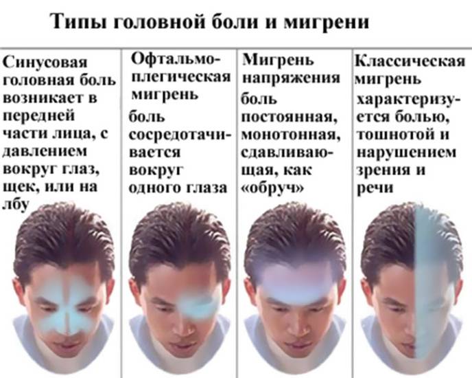 Виды головных болей