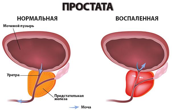 рисунок здоровой и воспаленной простаты