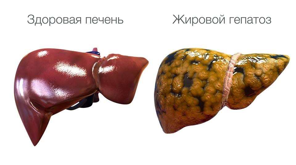 Гепатоз. Лечение и симптомы гепатоза печени.