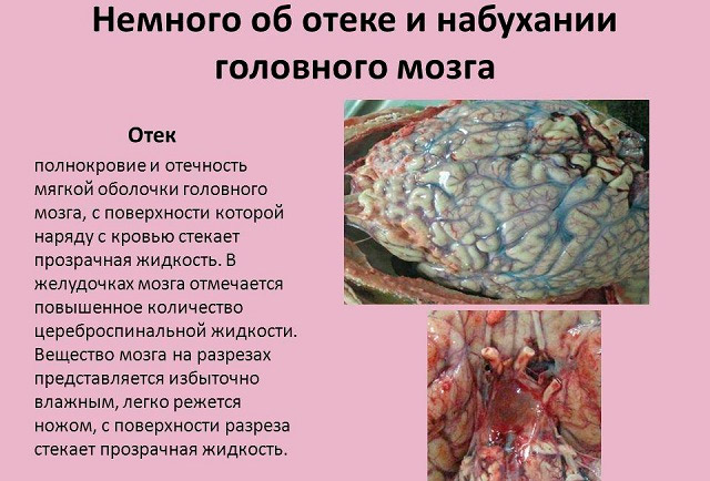 Отек головного мозга