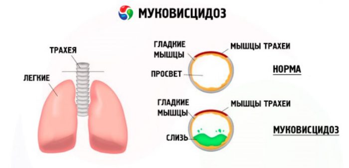 Муковисцидоз