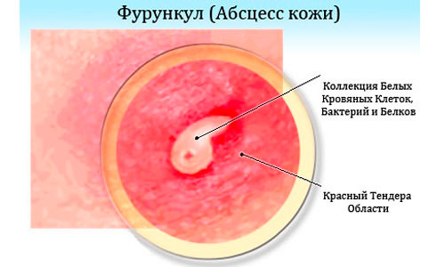 Фурункулез