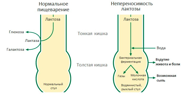 Непереносимость лактозы
