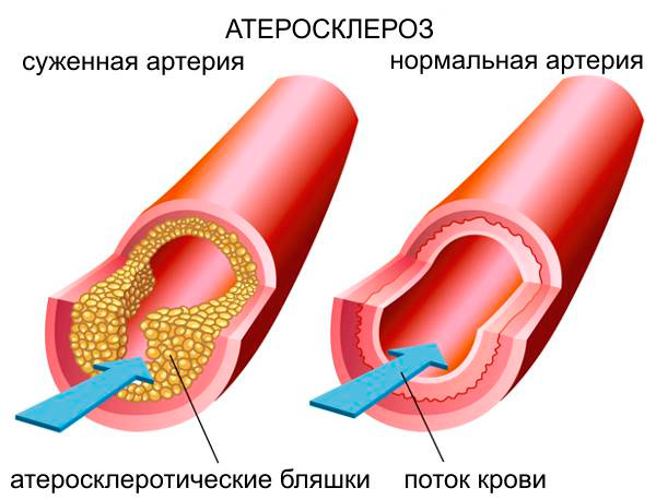 Атеросклероз