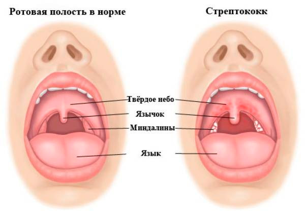 Стрептококк