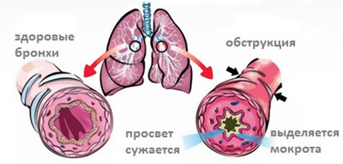 Обструктивный бронхит