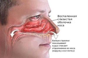 Европейский алгоритм лечения заложенности носа и насморка у взрослых. Топ 3 препаратов для быстрого выздоровления.