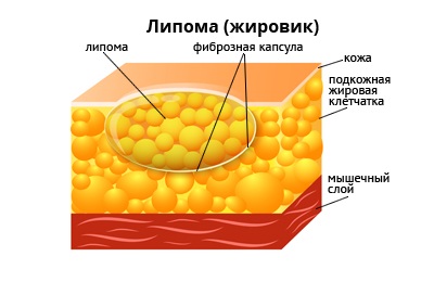 Липома
