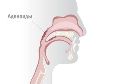 аденоиды